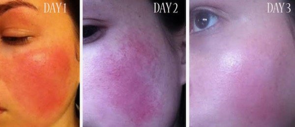Skin redness dermatitis